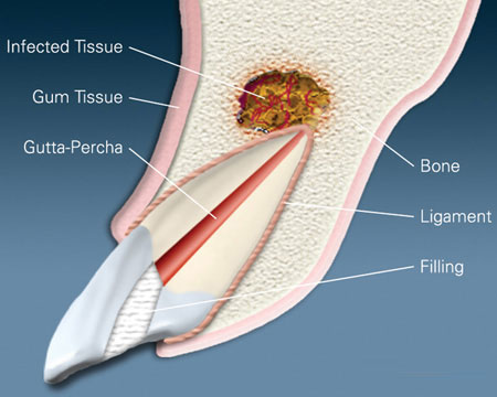 Infected Tissue - Apicoectomy: Procedure – Pros & Cons, and Detailed Guide