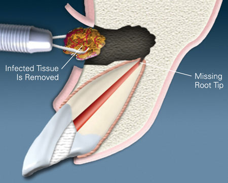 Tissue Removed