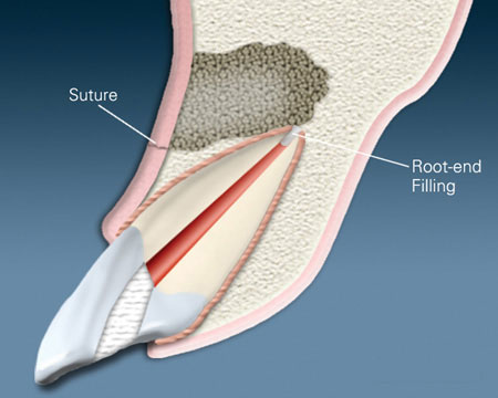 Suture Placed