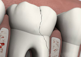 Fractured Cusp - Cracked Teeth Treatment – Surprise Endodontics