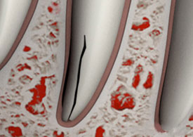 Vertical Root Fracture
